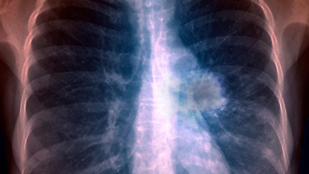 Image for post: Lung Cancer Diagnosis: What to Expect