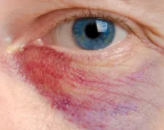 Black eye