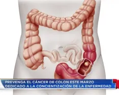 Colon Cancer