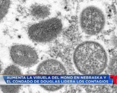 Monkeypox - Telemundo