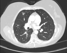 AI Lung Nodule