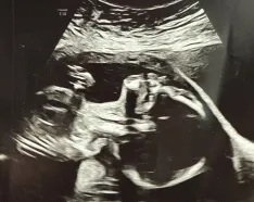 Ultrasound