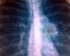 Image for post: Lung Cancer Diagnosis: What to Expect