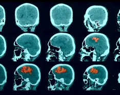 Image for post: Is it a Stroke? Time to BE FAST