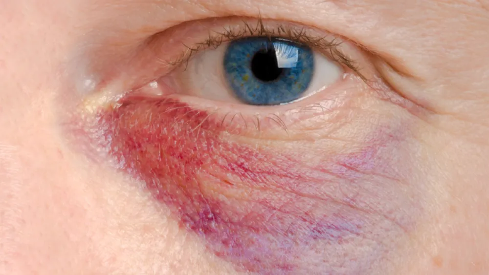Black eye
