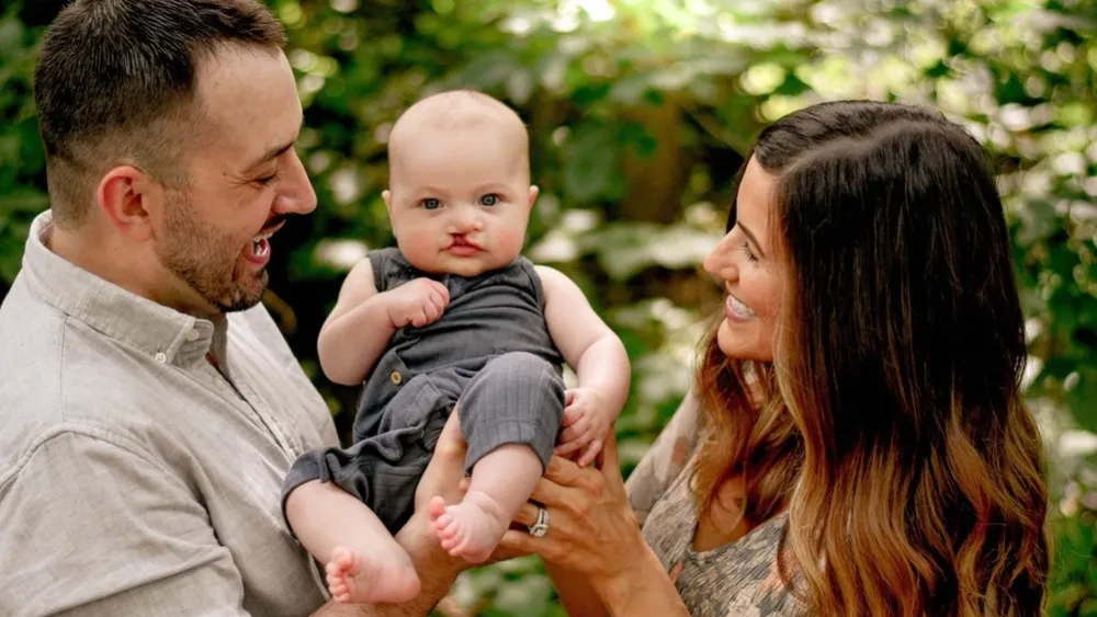 Cleft Lip and Palate