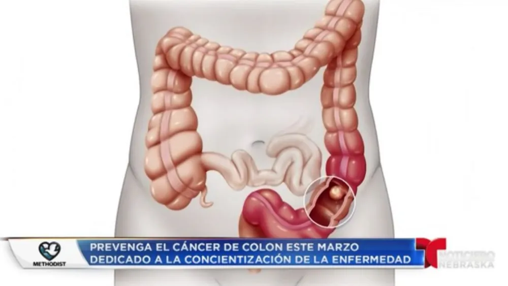 Colon Cancer