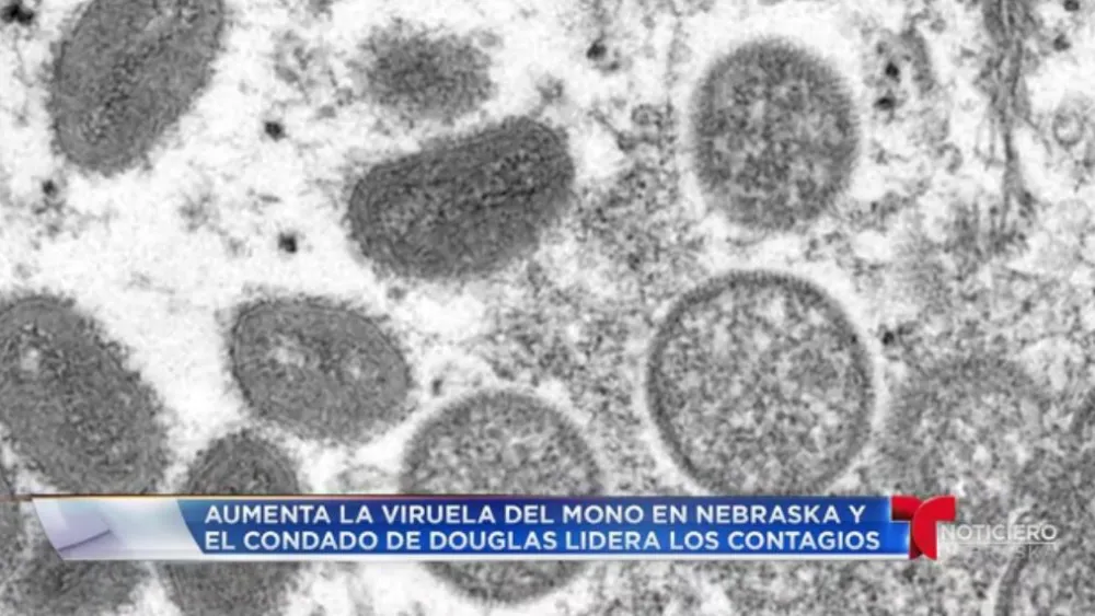 Monkeypox - Telemundo