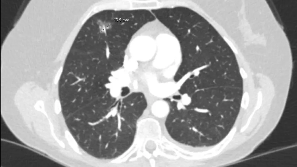 AI Lung Nodule