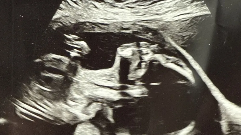 Ultrasound