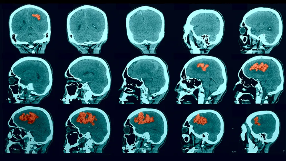 Image for post: Is it a Stroke? Time to BE FAST