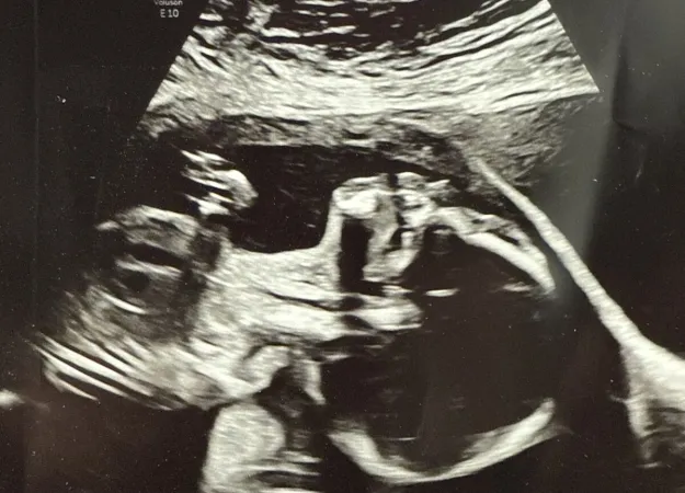 Ultrasound