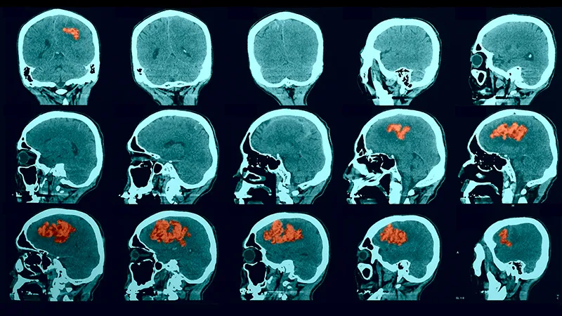 Image for post: Is it a Stroke? Time to BE FAST
